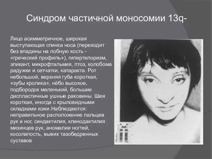 Синдром частичной моносомии 13q- Лицо асимметричное, широкая выступающая спинка носа (переходит без