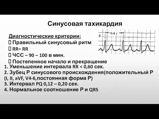 Синусовая тахикардия Диагностические критерии: Правильный синусовый ритм RR= RR ЧСС – 90