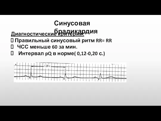 Синусовая брадикардия Диагностические критерии: Правильный синусовый ритм RR= RR ЧСС меньше 60