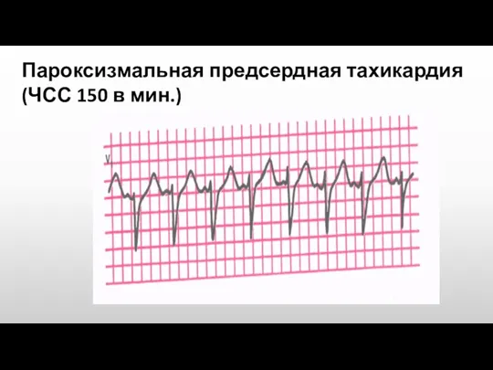 Пароксизмальная предсердная тахикардия (ЧСС 150 в мин.)