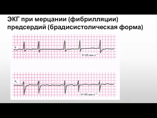 ЭКГ при мерцании (фибрилляции) предсердий (брадисистолическая форма)