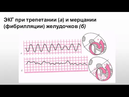 ЭКГ при трепетании (а) и мерцании (фибрилляции) желудочков (б)