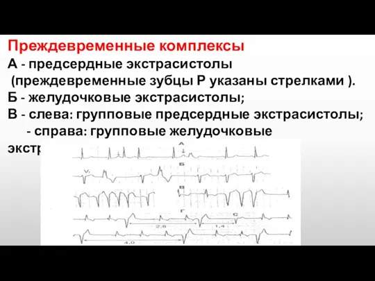 Преждевременные комплексы А - предсердные экстрасистолы (преждевременные зубцы Р указаны стрелками ).