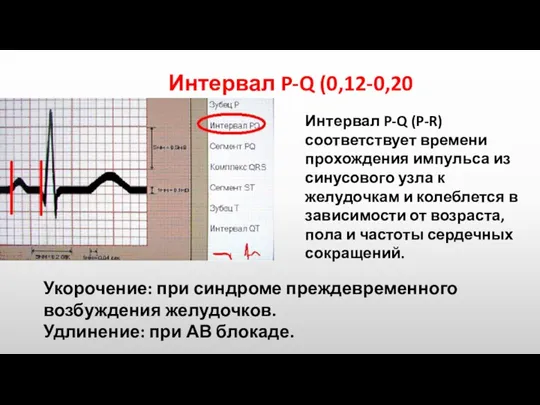 Интервал P-Q (0,12-0,20с.) Укорочение: при синдроме преждевременного возбуждения желудочков. Удлинение: при АВ