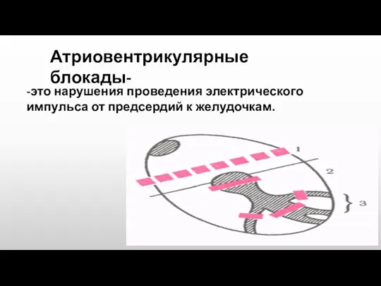 Атриовентрикулярные блокады- -это нарушения проведения электрического импульса от предсердий к желудочкам.