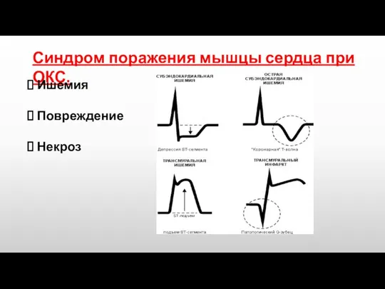 Синдром поражения мышцы сердца при ОКС. Ишемия Повреждение Некроз