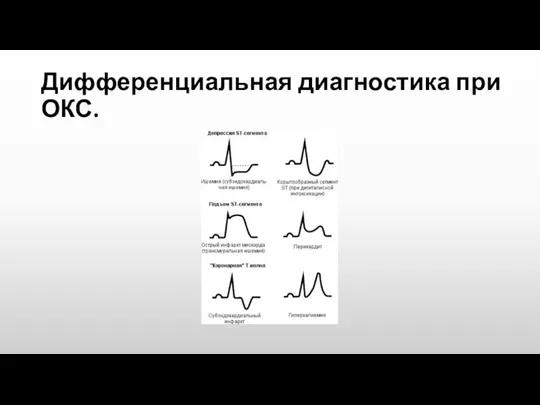 Дифференциальная диагностика при ОКС.