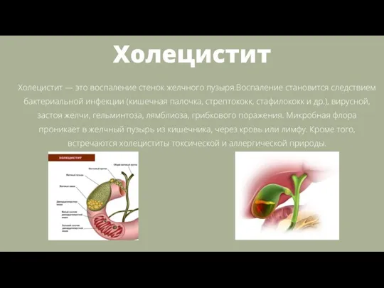 Холецистит Холецистит — это воспаление стенок желчного пузыря.Воспаление становится следствием бактериальной инфекции