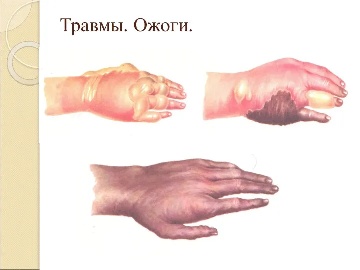 Травмы. Ожоги.