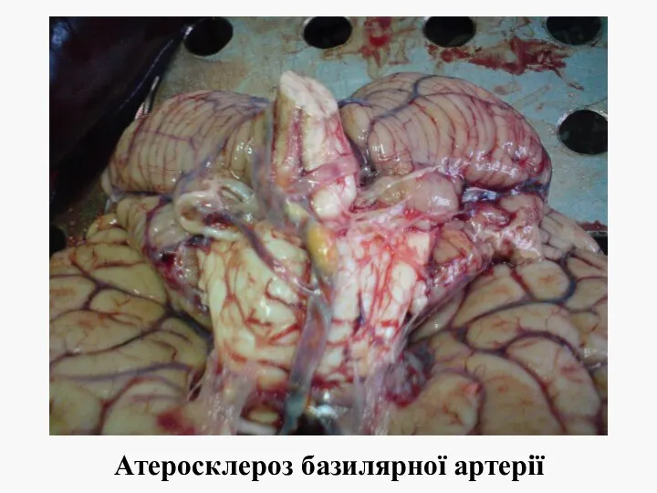 Атеросклероз базилярної артерії