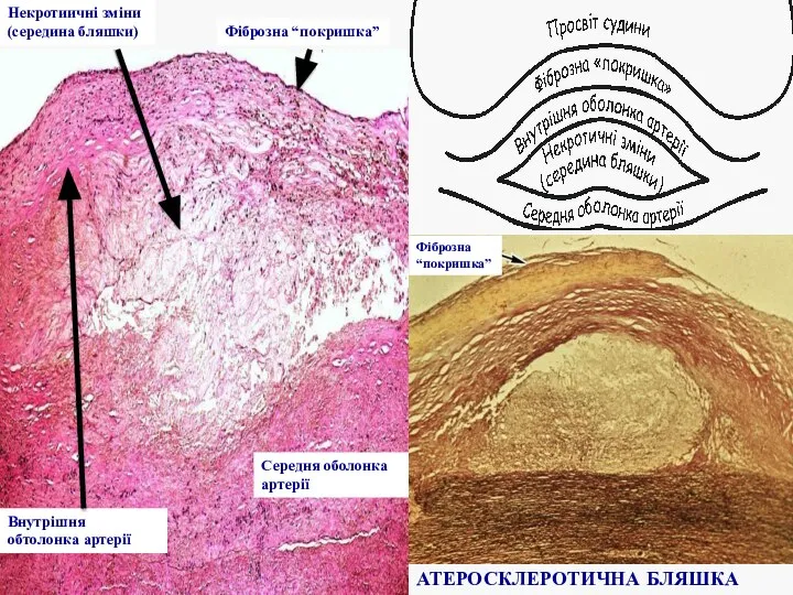 Фіброзна “покришка” Внутрішня обтолонка артерії Некротиичні зміни (середина бляшки) Середня оболонка артерії Фіброзна “покришка” АТЕРОСКЛЕРОТИЧНА БЛЯШКА