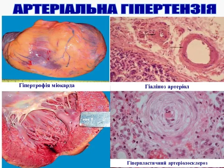 Гіпертрофія міокарда Гіаліноз артеріол Гіперпластичний артеріолосклероз АРТЕРІАЛЬНА ГІПЕРТЕНЗІЯ