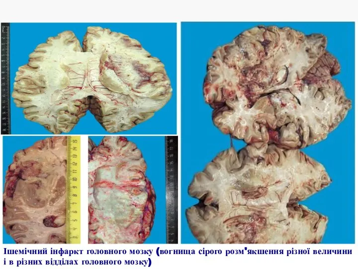 Ішемічний інфаркт головного мозку (вогнища сірого розм'якшення різної величини і в різних відділах головного мозку)
