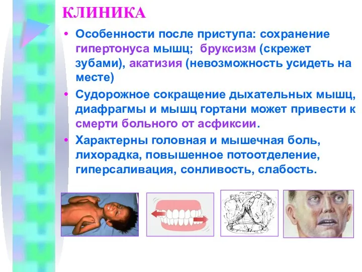 КЛИНИКА Особенности после приступа: сохранение гипертонуса мышц; бруксизм (скрежет зубами), акатизия (невозможность