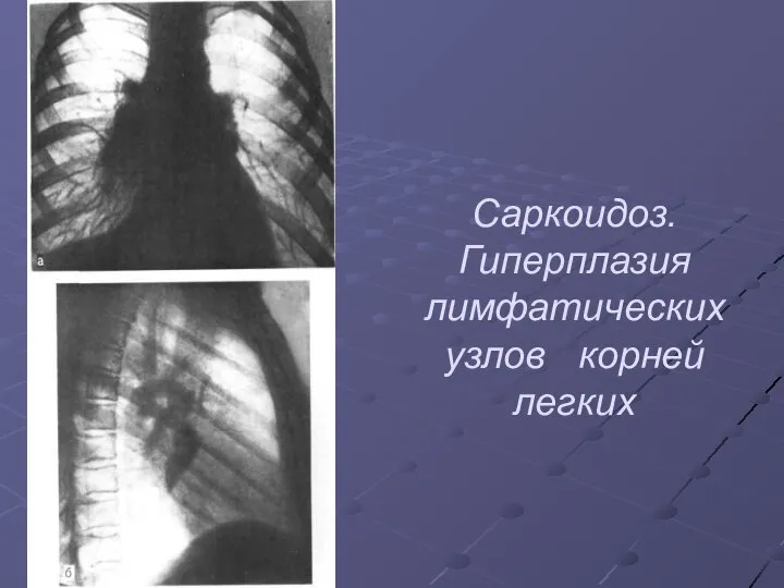 Саркоидоз. Гиперплазия лимфатических узлов корней легких