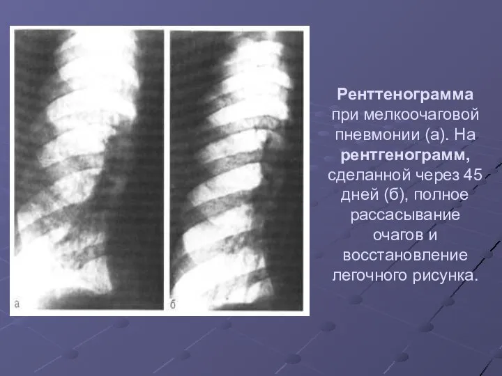 Ренттенограмма при мелкоочаговой пневмонии (а). На рентгенограмм, сделанной через 45 дней (б),