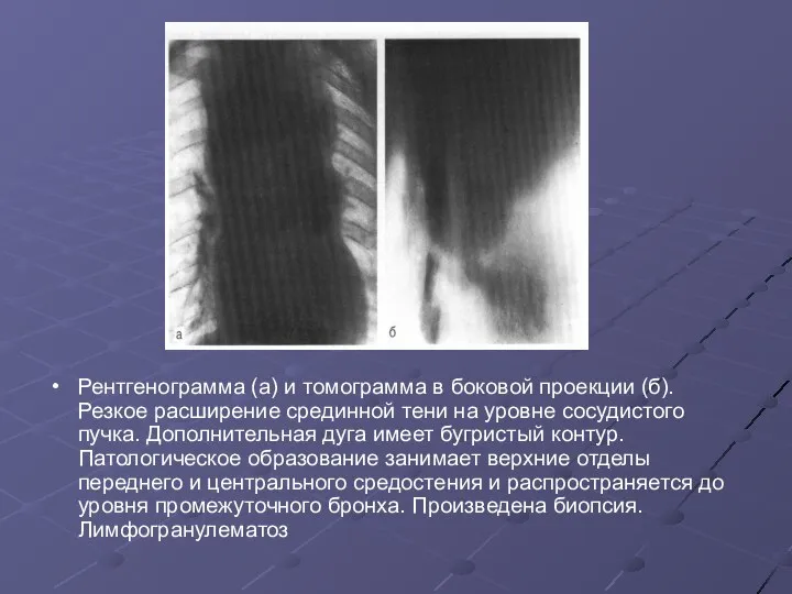 Рентгенограмма (а) и томограмма в боковой проекции (б). Резкое расширение срединной тени