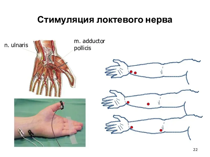 Стимуляция локтевого нерва n. ulnaris m. adductor pollicis