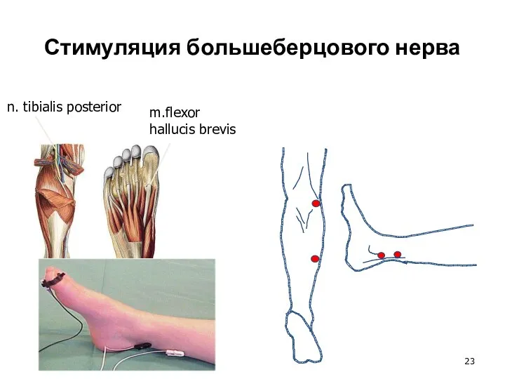 Стимуляция большеберцового нерва n. tibialis posterior m.flexor hallucis brevis