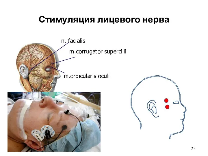 Стимуляция лицевого нерва n. facialis m.orbicularis oculi m.corrugator supercilii