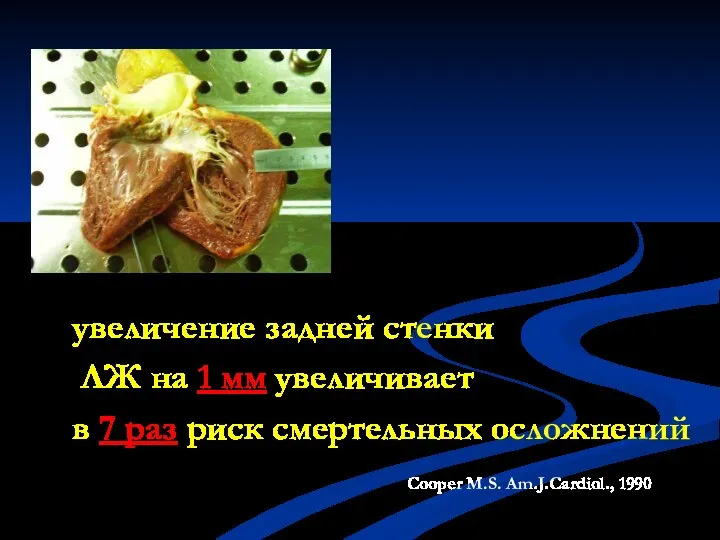 увеличение задней стенки ЛЖ на 1 мм увеличивает в 7 раз риск