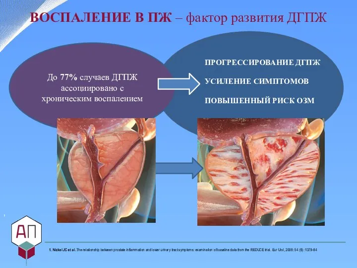 До 77% случаев ДГПЖ ассоциировано с хроническим воспалением ВОСПАЛЕНИЕ В ПЖ –