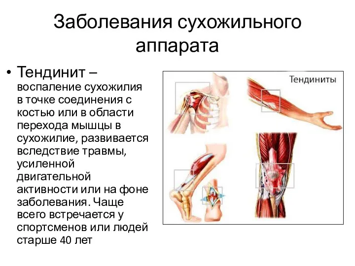 Заболевания сухожильного аппарата Тендинит – воспаление сухожилия в точке соединения с костью