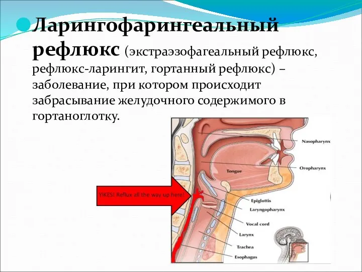 Ларингофарингеальный рефлюкс (экстраэзофагеальный рефлюкс, рефлюкс-ларингит, гортанный рефлюкс) – заболевание, при котором происходит