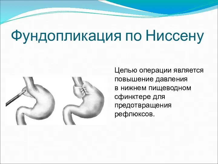 Фундопликация по Ниссену Целью операции является повышение давления в нижнем пищеводном сфинктере для предотвращения рефлюксов.