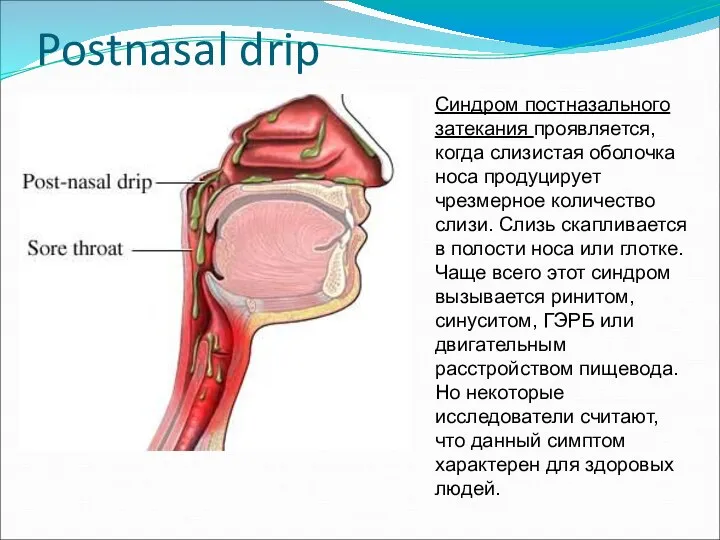 Postnasal drip Синдром постназального затекания проявляется, когда слизистая оболочка носа продуцирует чрезмерное