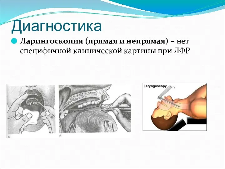 Диагностика Ларингоскопия (прямая и непрямая) – нет специфичной клинической картины при ЛФР