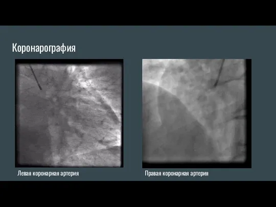 Коронарография Левая коронарная артерия Правая коронарная артерия