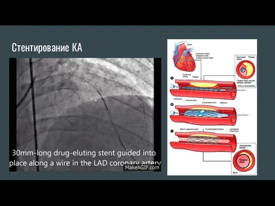 Стентирование КА
