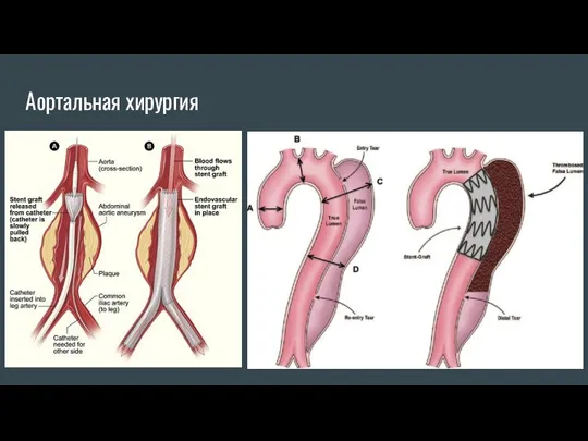 Аортальная хирургия