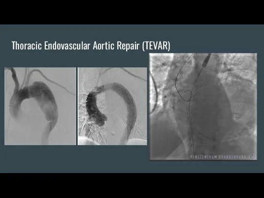 Thoracic Endovascular Aortic Repair (TEVAR)