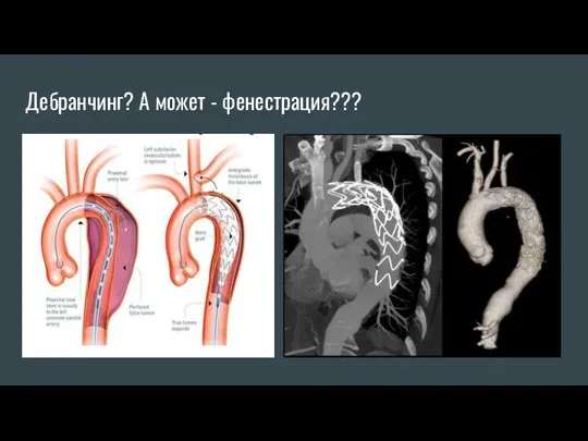 Дебранчинг? А может - фенестрация???