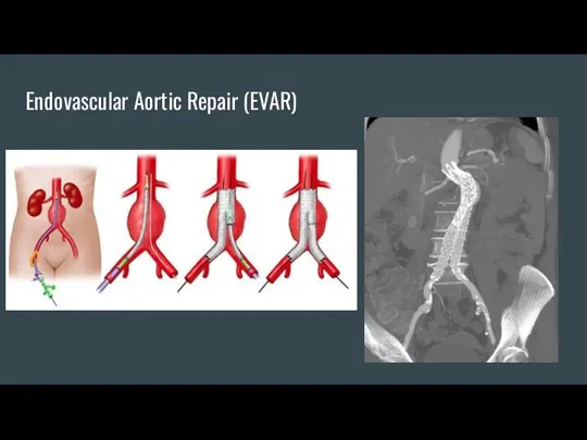 Endovascular Aortic Repair (EVAR)