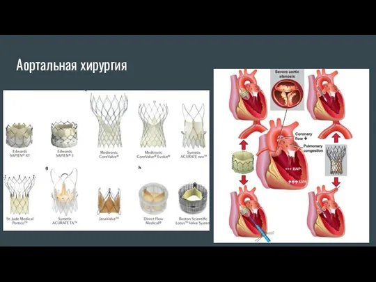 Аортальная хирургия