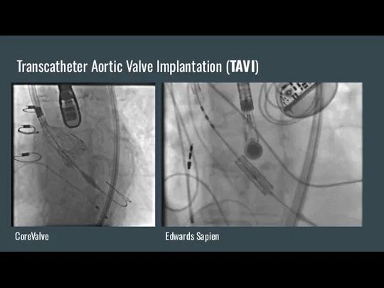 Transcatheter Aortic Valve Implantation (TAVI) CoreValve Edwards Sapien