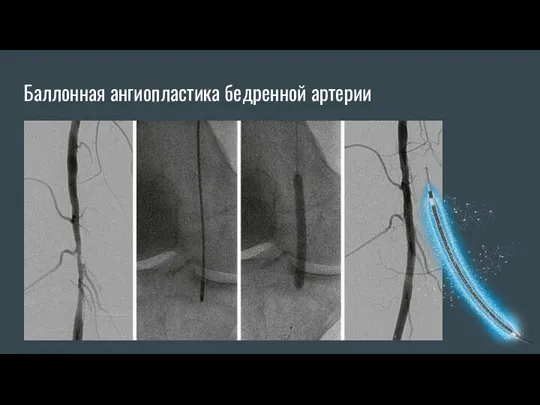 Баллонная ангиопластика бедренной артерии