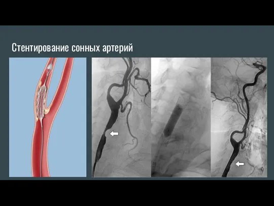 Стентирование сонных артерий