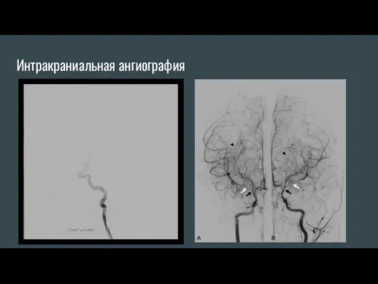 Интракраниальная ангиография