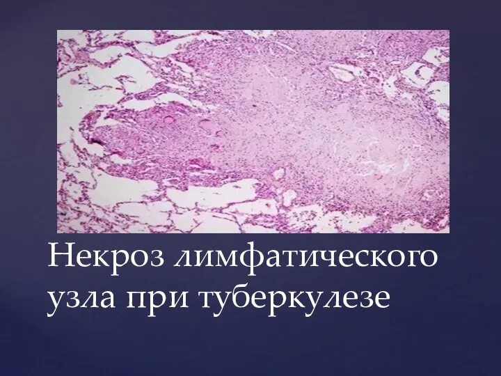 Некроз лимфатического узла при туберкулезе