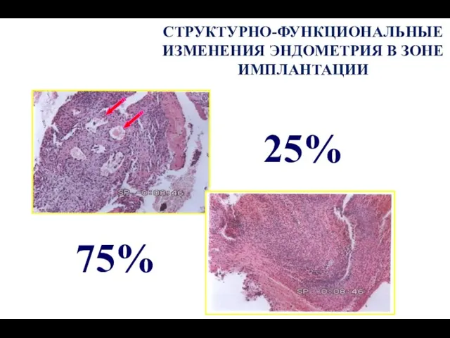 75% 25% СТРУКТУРНО-ФУНКЦИОНАЛЬНЫЕ ИЗМЕНЕНИЯ ЭНДОМЕТРИЯ В ЗОНЕ ИМПЛАНТАЦИИ