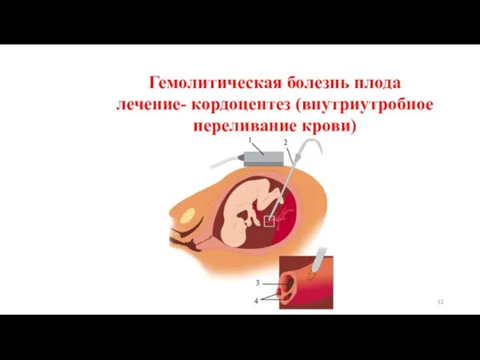 Гемолитическая болезнь плода лечение- кордоцентез (внутриутробное переливание крови)