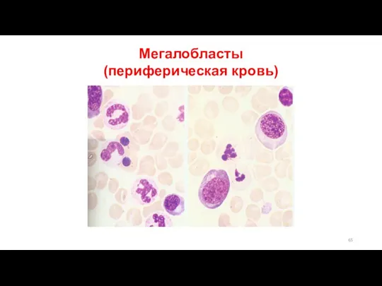 Мегалобласты (периферическая кровь)