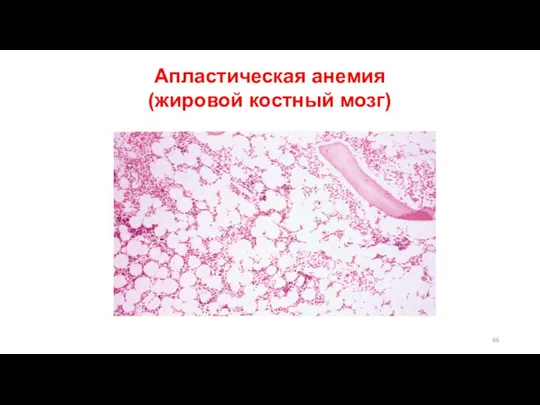 Апластическая анемия (жировой костный мозг)