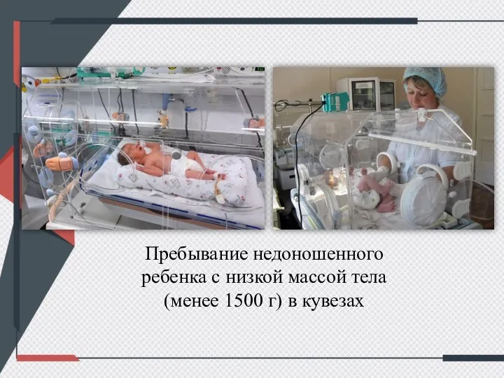 Пребывание недоношенного ребенка с низкой массой тела(менее 1500 г) в кувезах