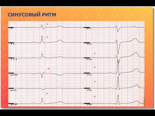 СИНУСОВЫЙ РИТМ + + + + + + + -