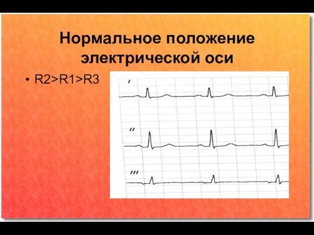 Нормальное положение электрической оси R2>R1>R3